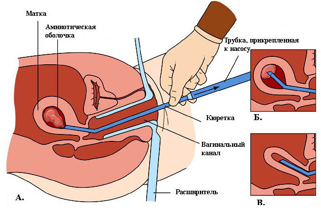 Мини-аборт: сроки проведения, осложнения и отдаленные последствия Мини-аборт: сроки проведения, осложнения и отдаленные последствия