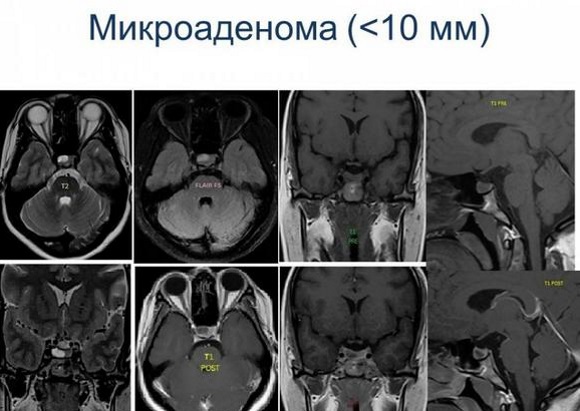 Что такое аденома и микроаденома гипофиза головного мозга Что такое аденома и микроаденома гипофиза головного мозга